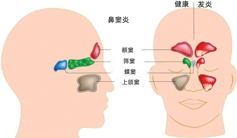 鼻窦炎图解图片