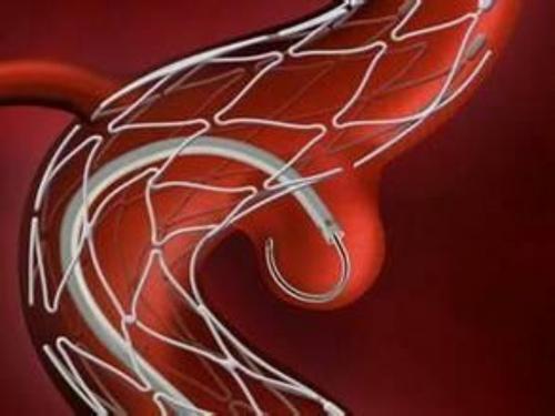 即在颅内动脉瘤瘤体内放置弹簧圈,称为"栓塞治疗",减少血流对瘤体血管