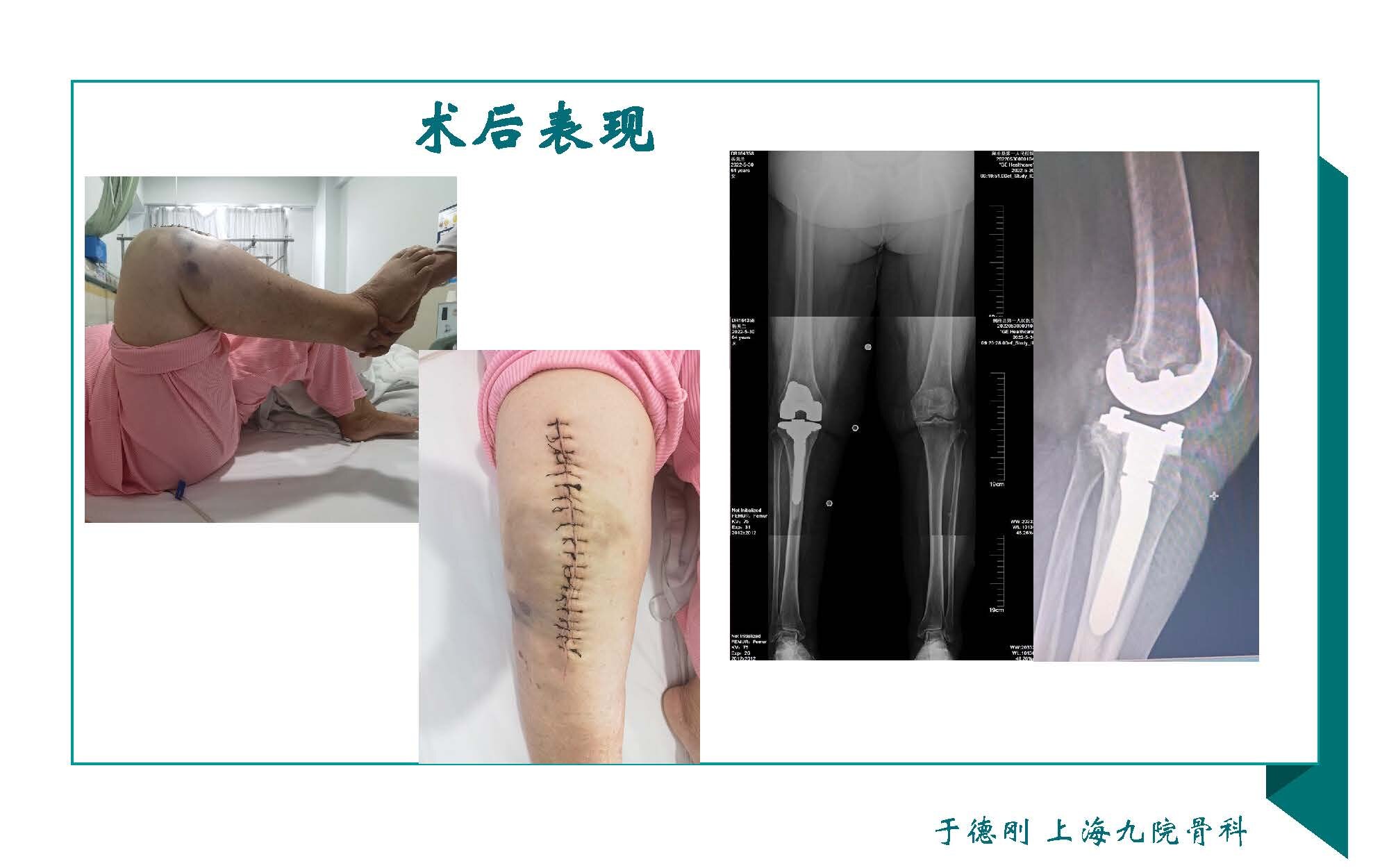 Obesity and TKA_页面_20.jpg