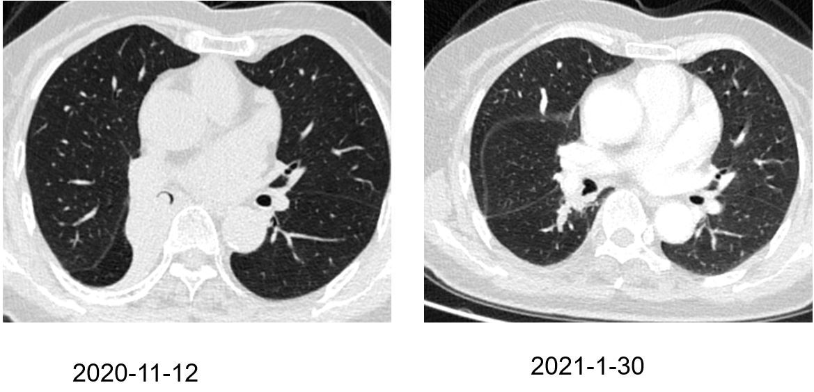 肺部积水严重不严重 1IYBAGH8hd-AUmzkAAFqEDZydwY539.jpg?_ms_=00a2