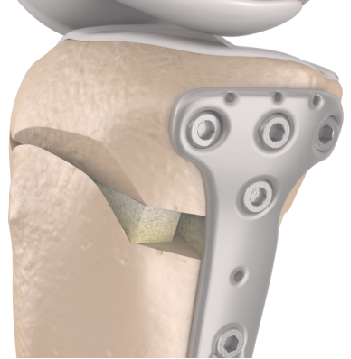 精准保膝新技术——高位胫骨截骨术(hto)_膝关节炎_膝关节炎治疗方式