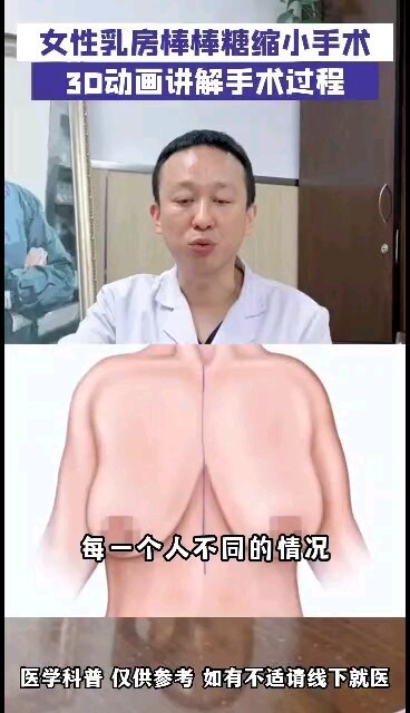 女性乳房棒棒糖缩胸法手术，3D动画讲解手术过程让你更直观认识