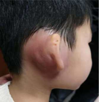 儿童外耳道胆脂瘤图片图片