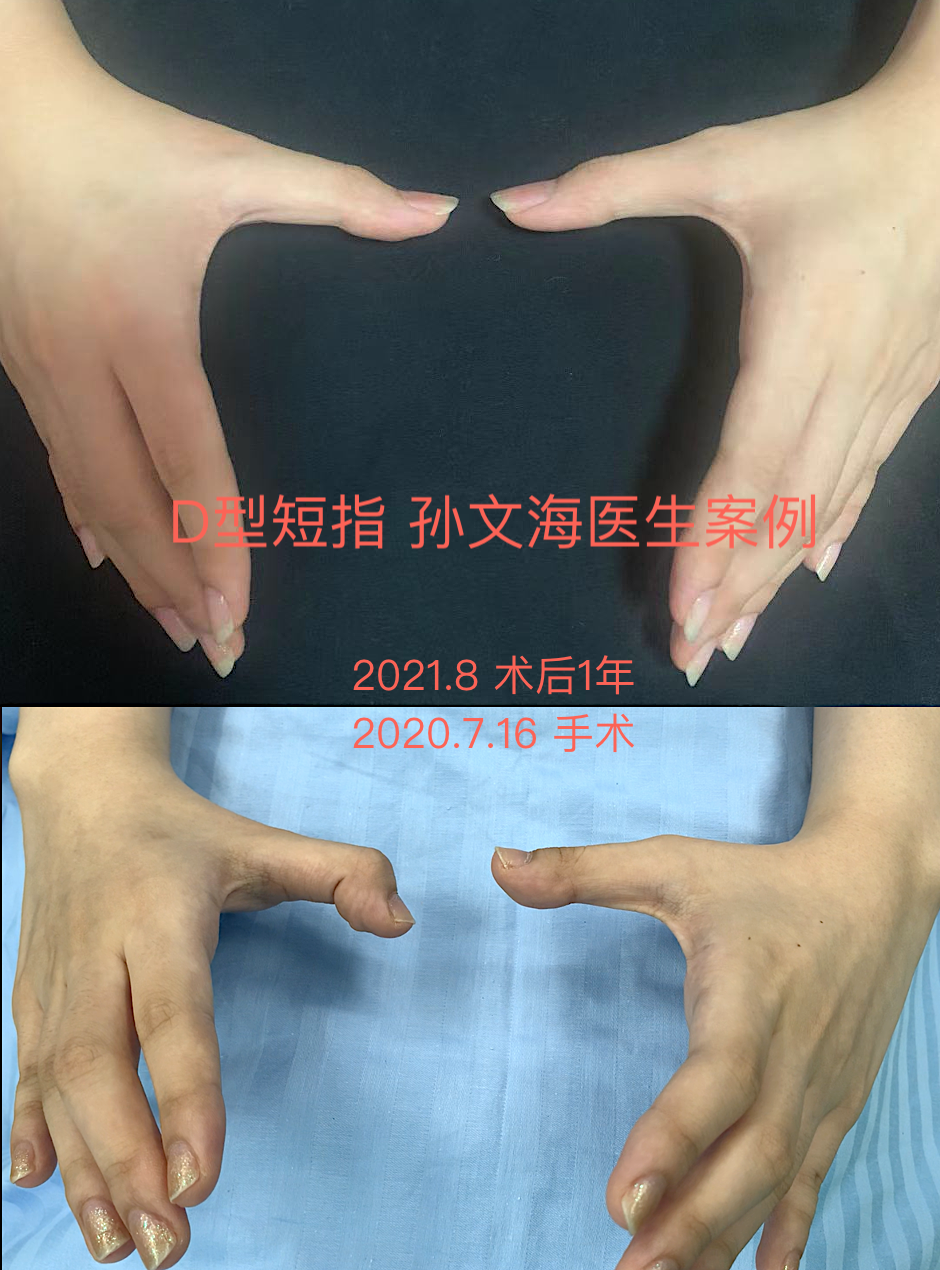 d型短指症的手术方法(附案例集)_短指症_短指症治疗方式 - 好大夫在线