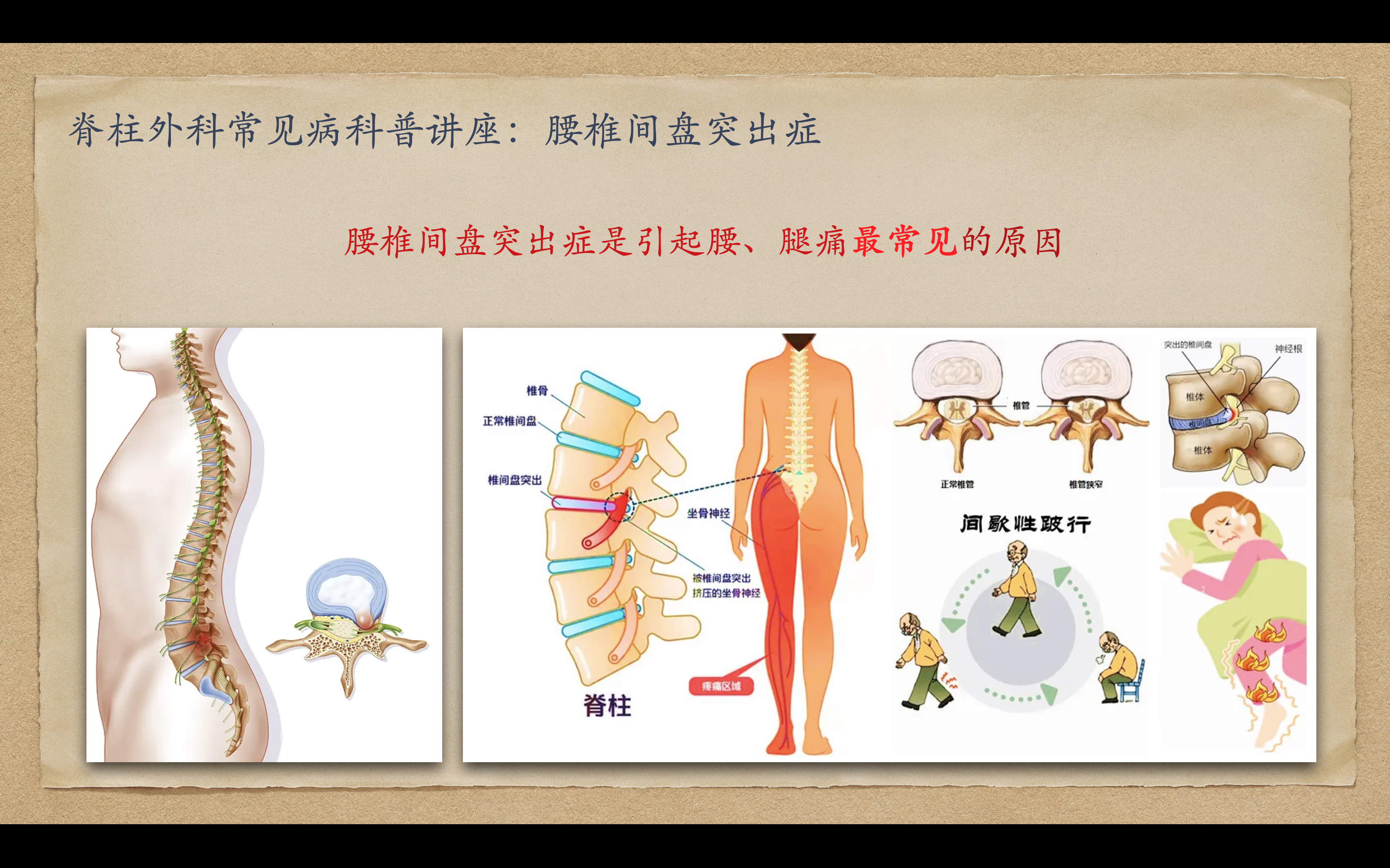 郭晶晶腰椎间盘突出图片