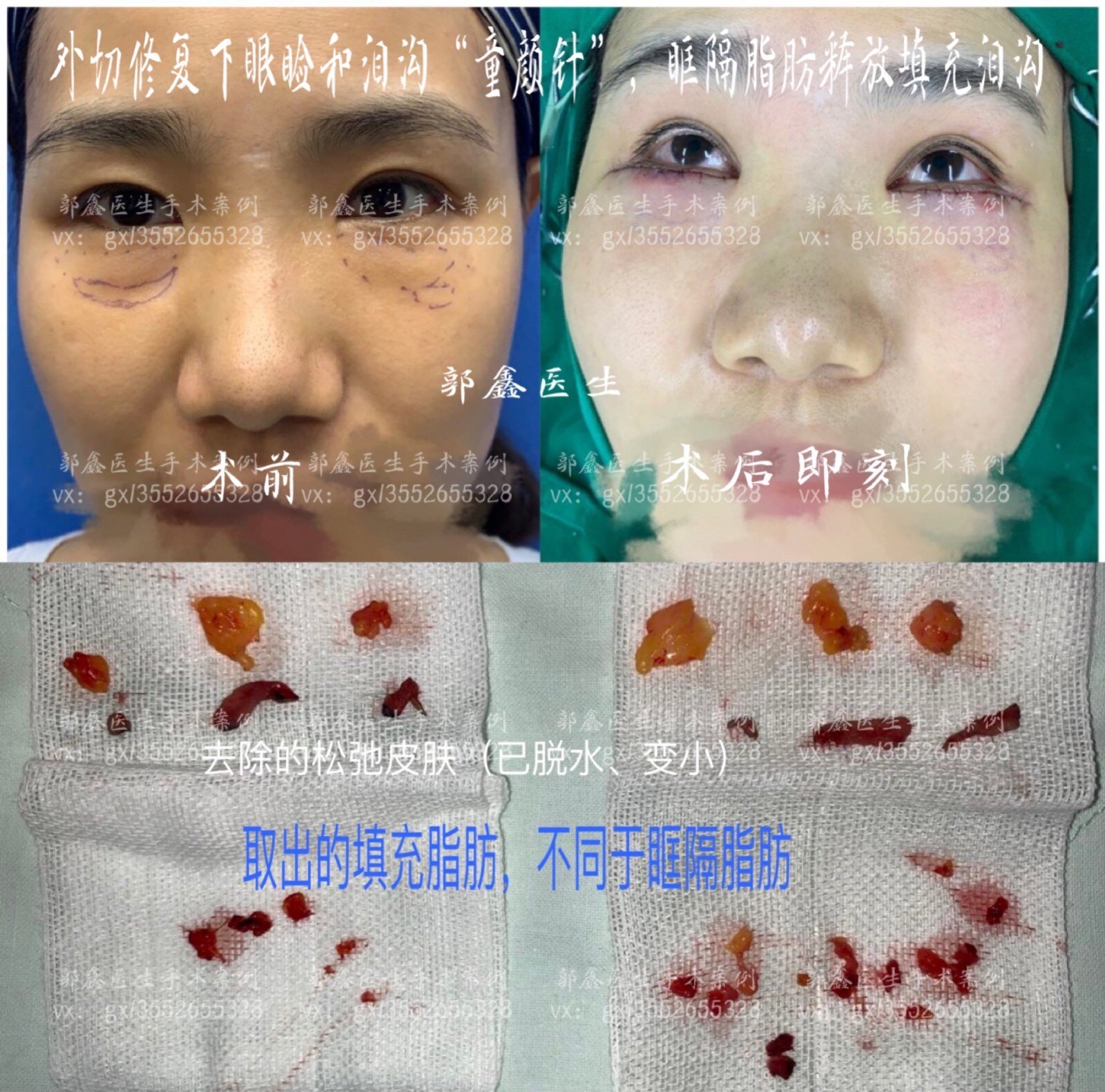 生长因子,童颜针,脂肪填充修复案例和简介(郭鑫医生)