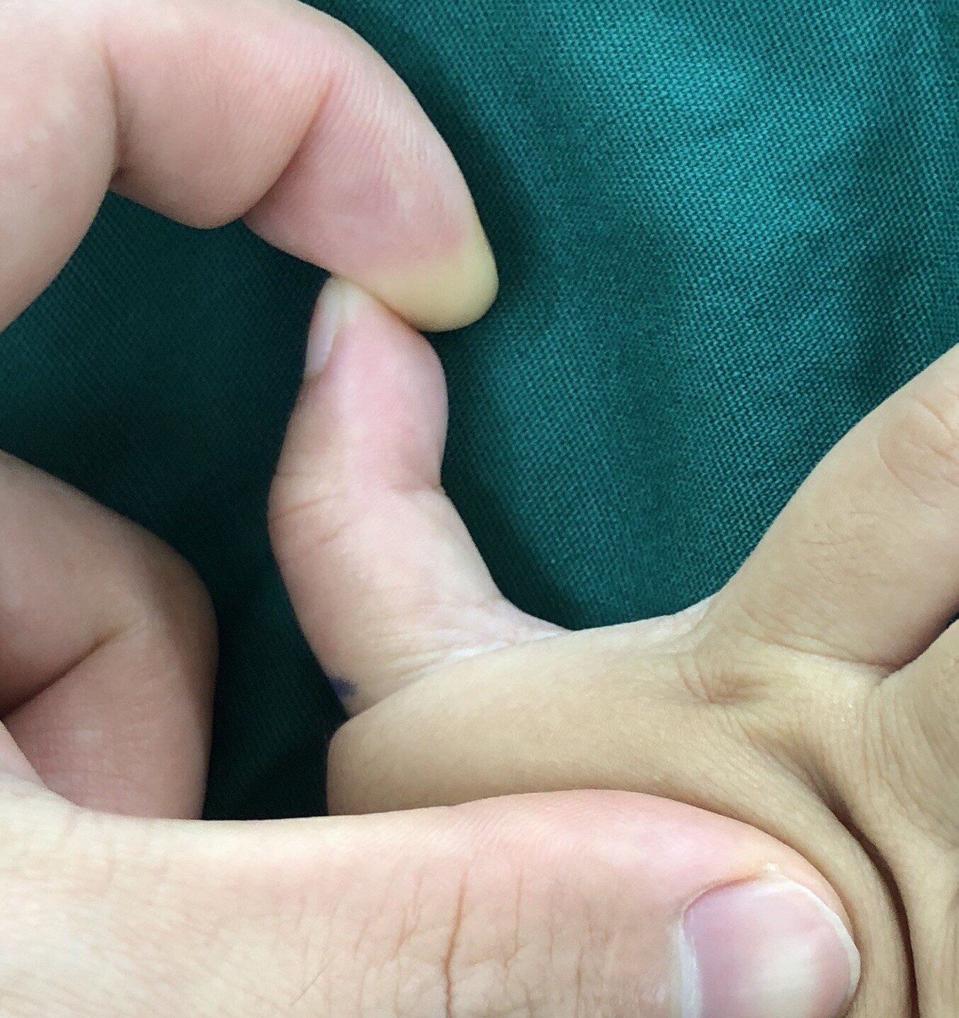 孩子大拇指伸不直,原来是狭窄性腱鞘炎,微创松解伸直就舒服啦 