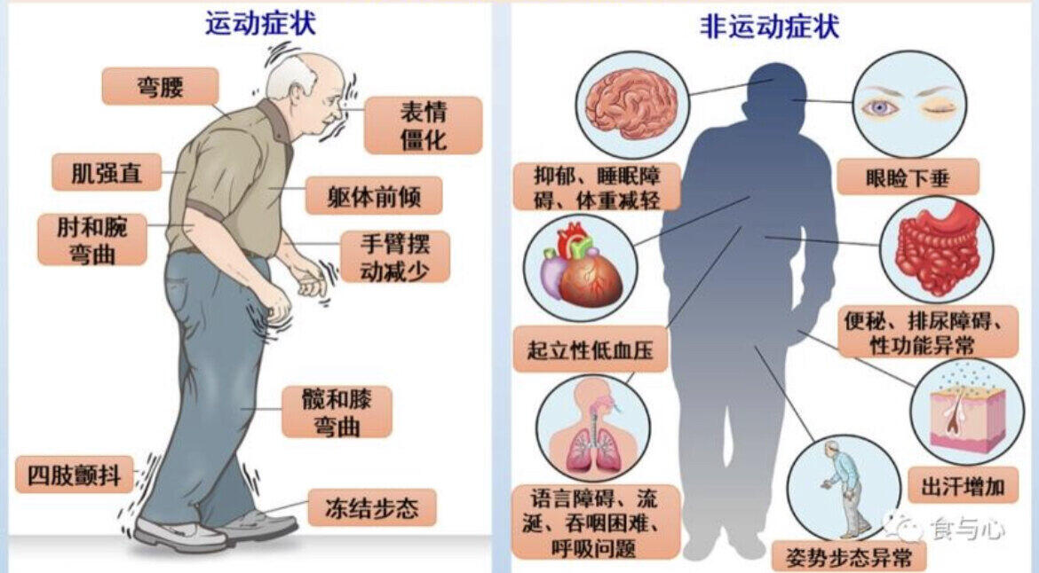 帕金森病主要症状图片图片