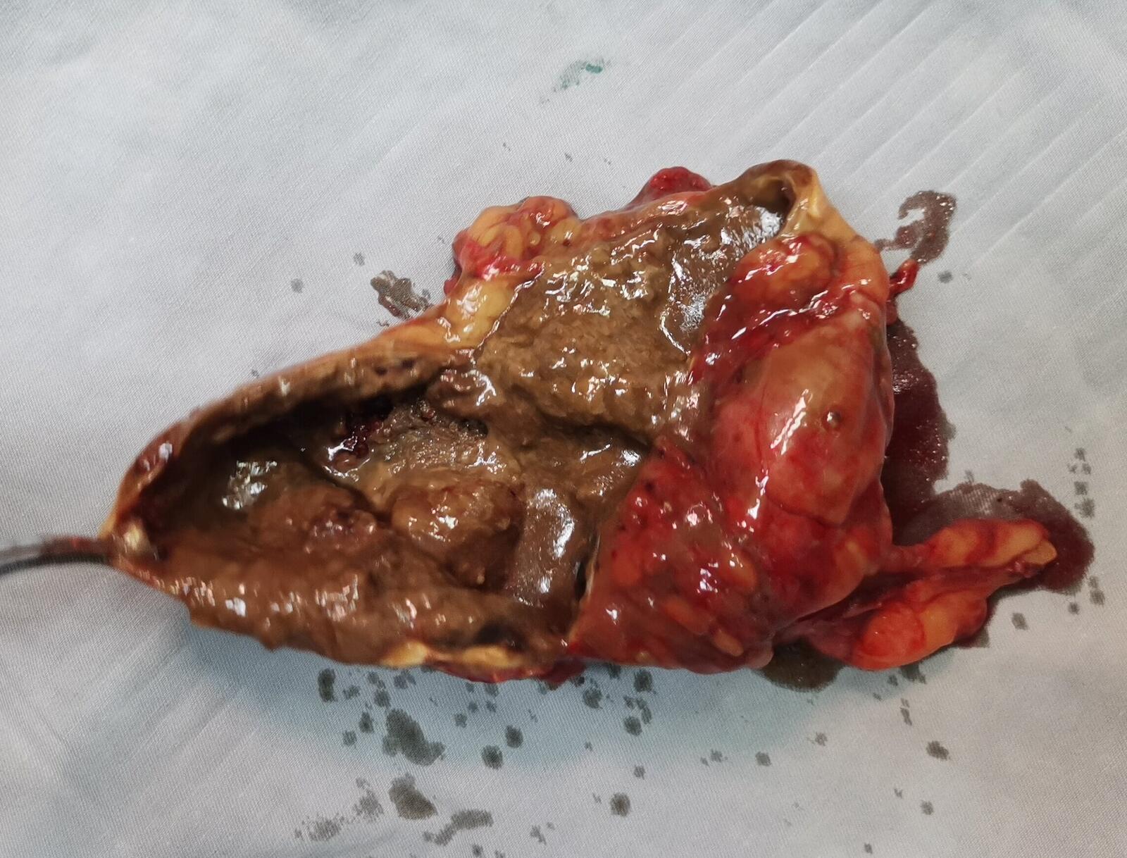 粘液腺瘤图片