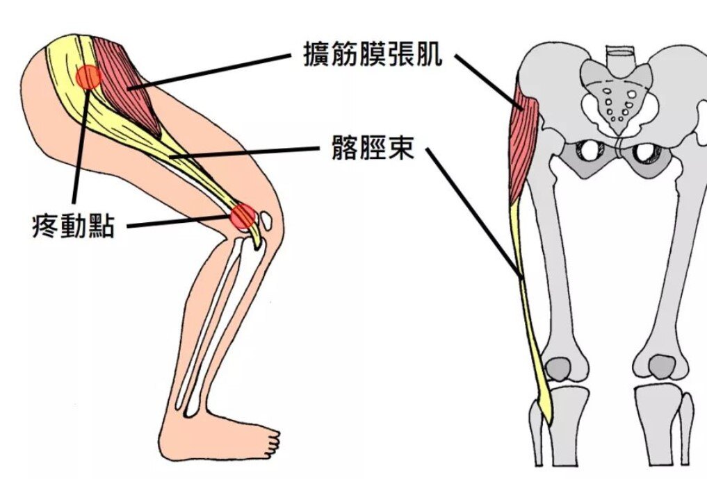 典型病例的压疼位于股骨外上髁处,有的病例压疼位置则比较模糊