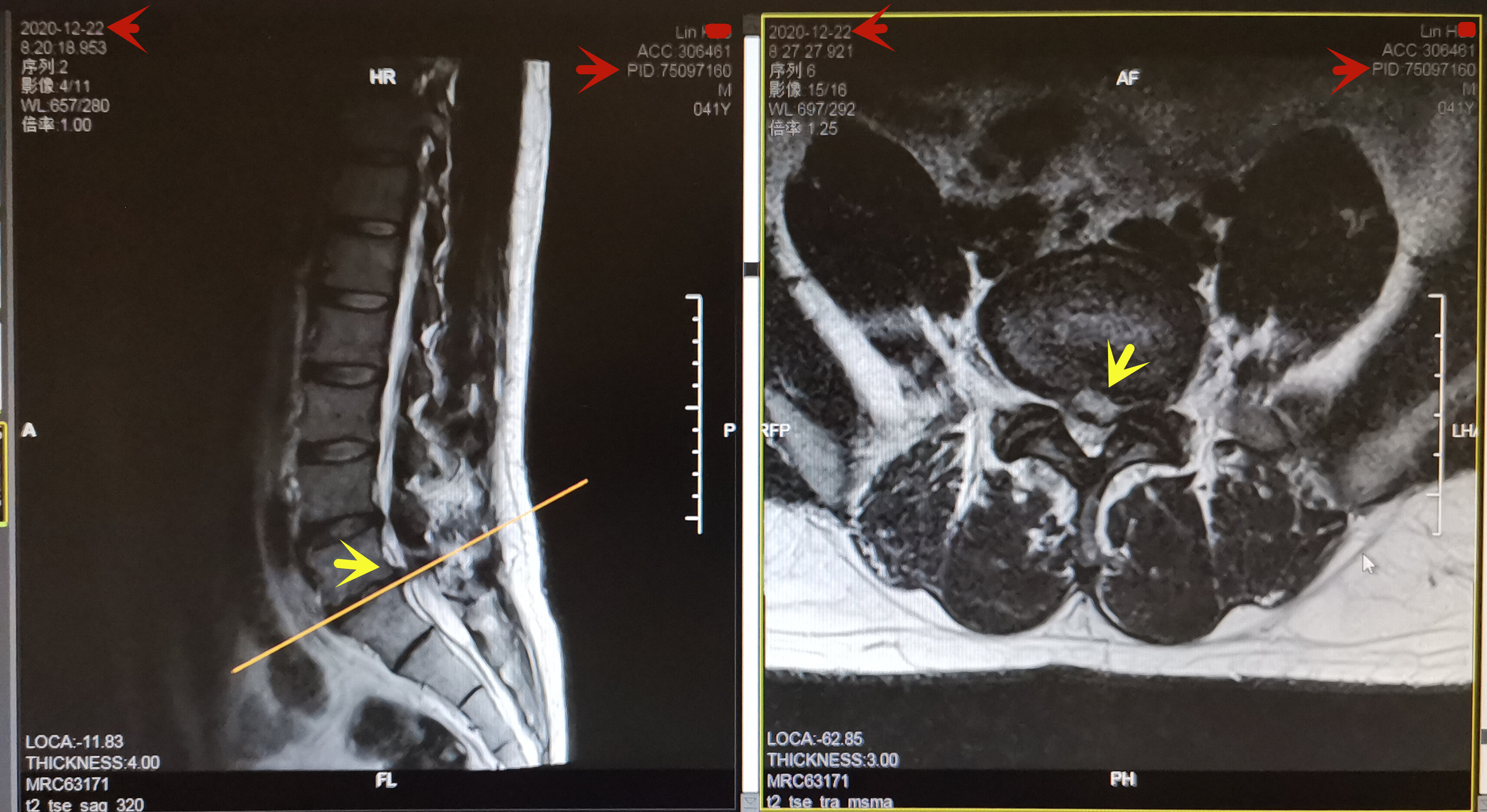 20201222林浩腰椎mri