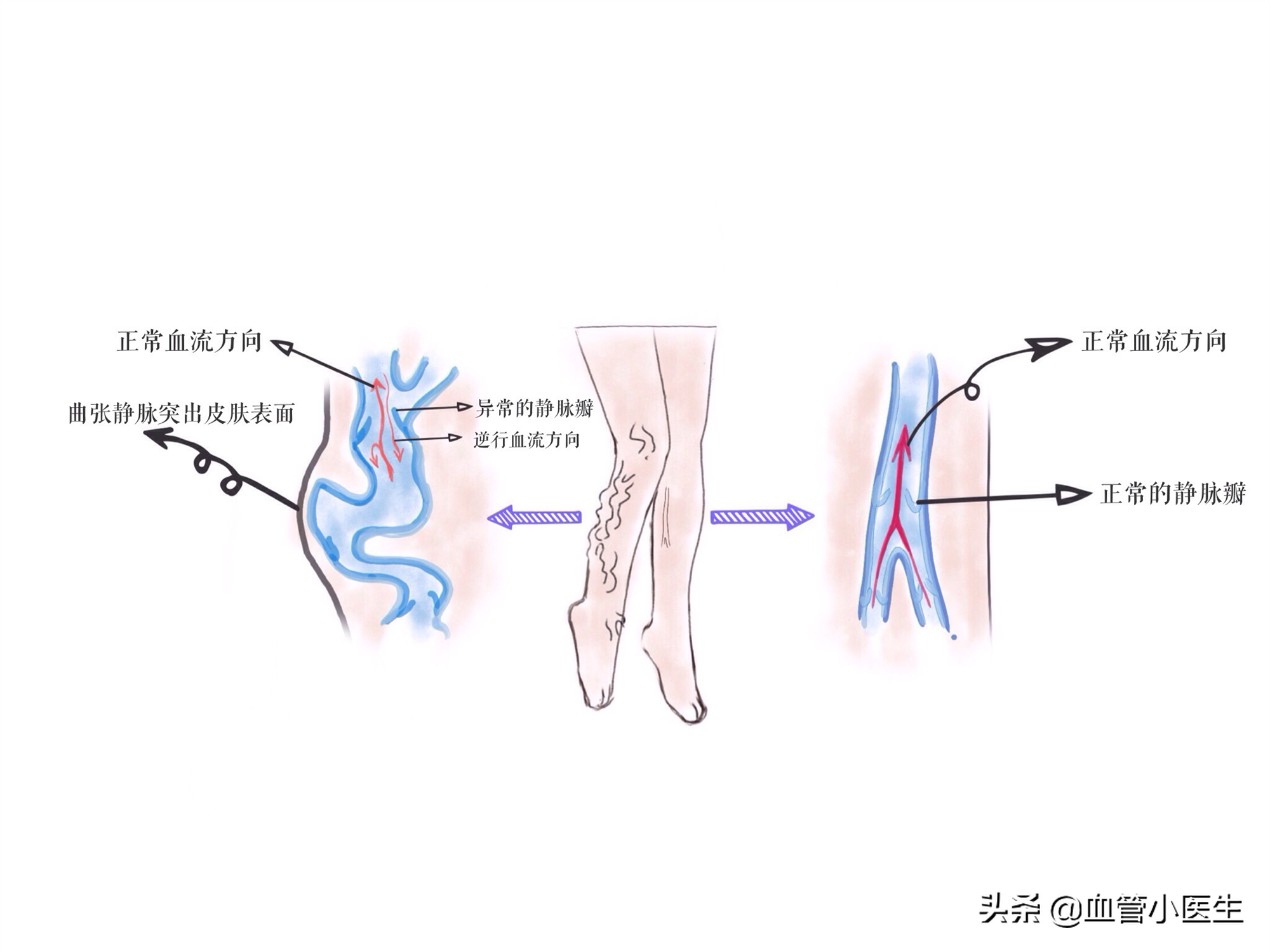 <!--HAODF:8:jingmaiquzhang--><!--HAODF:8:jingmaiquzhang-->静脉曲张<!--HAODF:/8:jingmaiquzhang--><!--HAODF:/8:jingmaiquzhang-->的那些事（1）