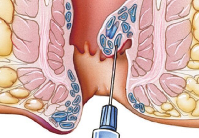 20-DDI-011-Hemorrhoids-650x450.jpg