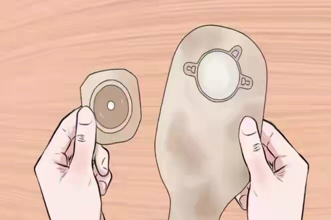 造口周围机械性皮肤损伤_疤痕_发病原因_如何预防 - 好大夫在线