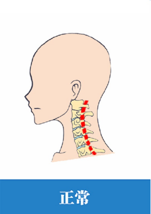 查出頸椎生理曲度變直或反弓,怎麼做才能恢復?需要手術嗎?