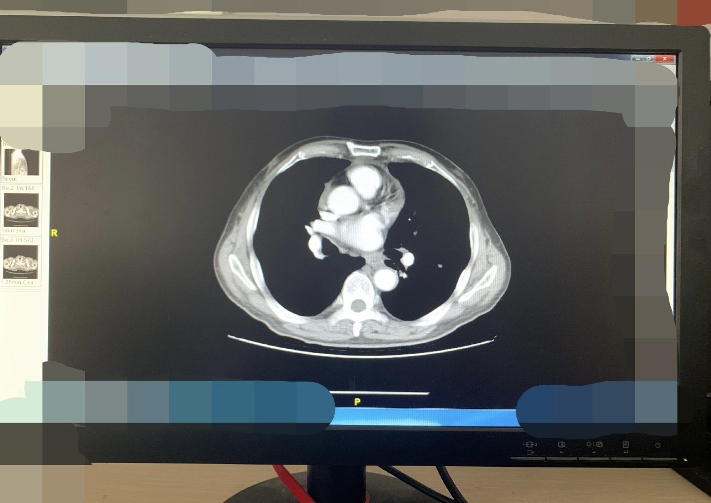 想找医生朋友或者网上看病,怎么给你的ct胶片拍照? - 好大夫在线