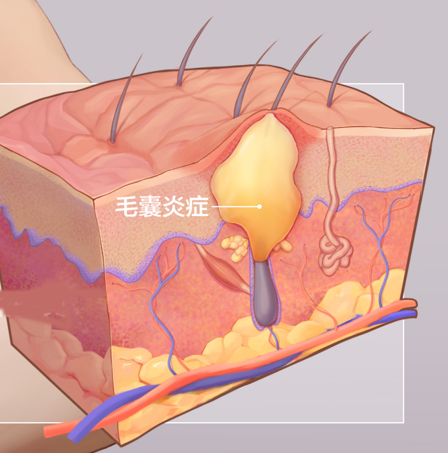 这7类人群易患毛囊炎!