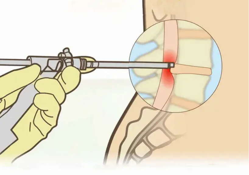 腰椎間盤突出患者什麼情況需要做手術了?-疼痛科嶽劍寧830.png