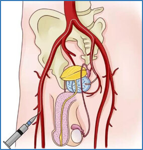 前列腺动脉栓塞治疗具有手术指征广,疗效显著,术后恢复快,并发症少等