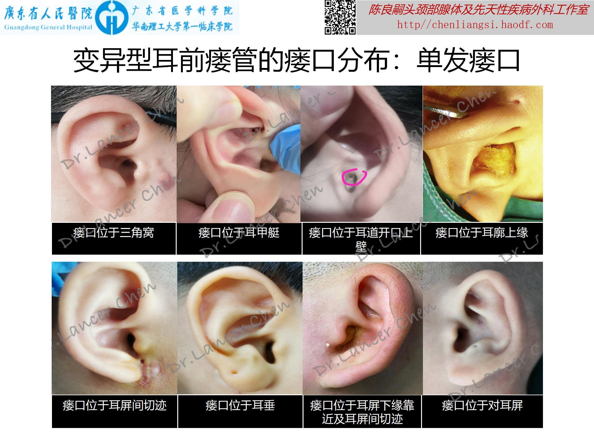 耳前瘘管结构图图片