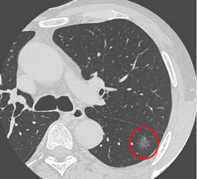 肺部结节_介绍_相关检查 - 好大夫在线