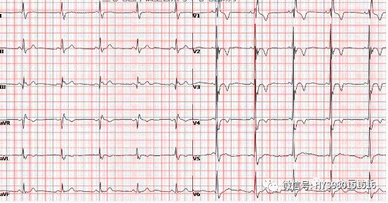 肺栓塞的心电图s1q3t3图片
