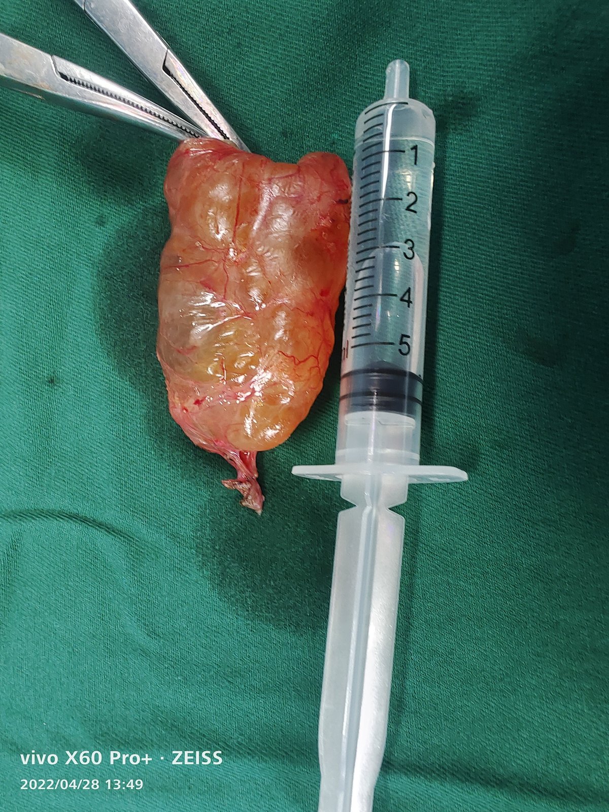 淋巴管瘤_淋巴管瘤_淋巴管瘤介绍 - 好大夫在线