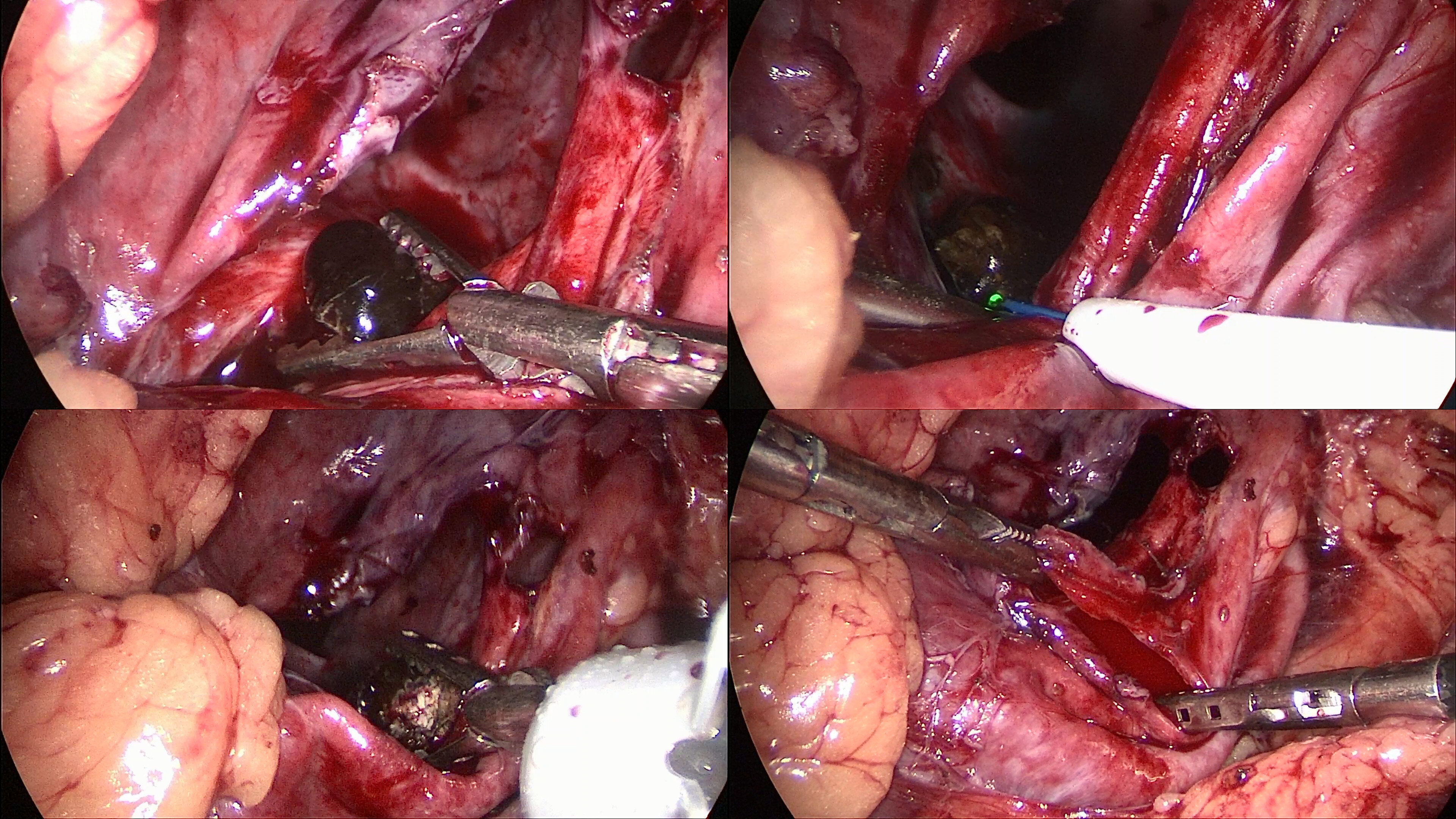 复杂性上尿路结石治疗需要建立个体化治疗体系_尿道结石_尿道结石治疗