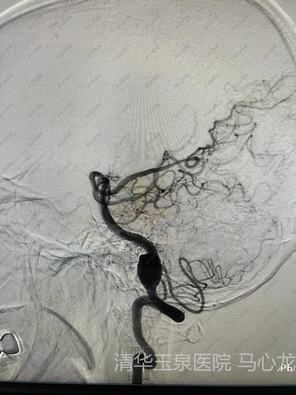 脑夹层动脉瘤图片