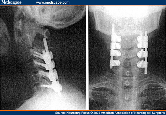 颈椎侧块及侧块螺钉技术
