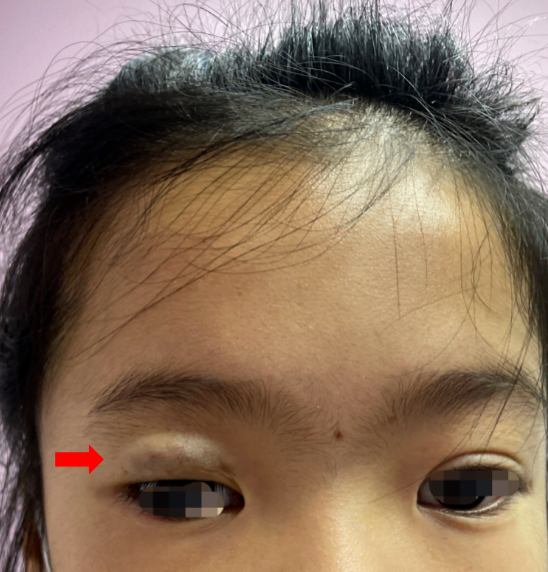 眼睑部血管瘤(先天性血管瘤)介入微创治疗案例