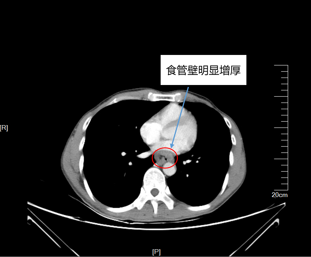 典型病例之食管癌伴淋巴结转移_食道癌_介绍_检查 - 好大夫在线