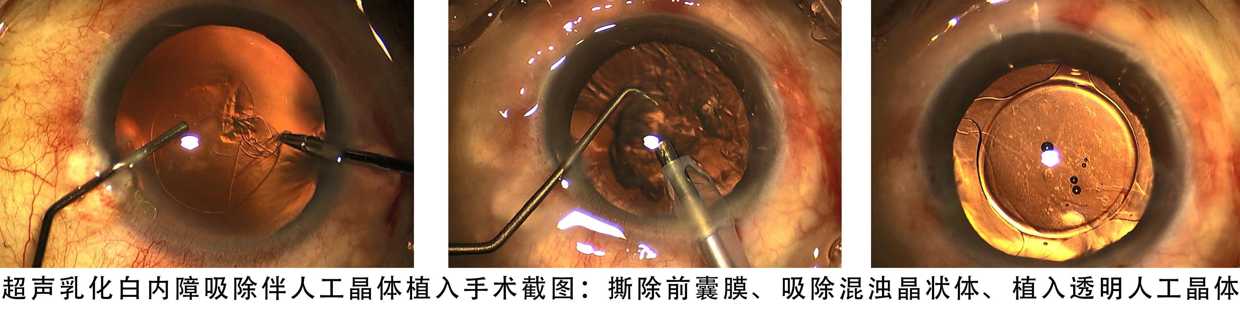 重新看清世界：白内障手术全攻略白内障介绍治疗方式治疗介绍 好大夫在线 