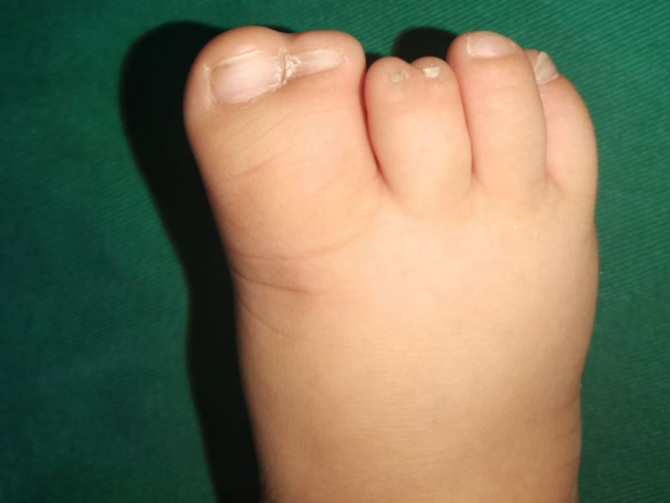 宝宝脚趾畸形图片