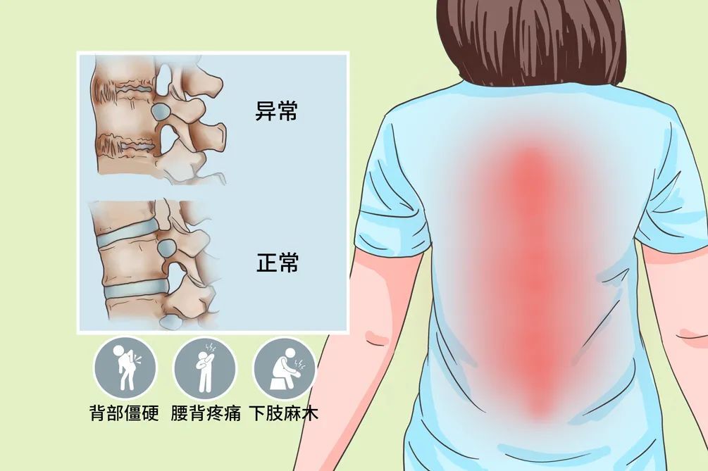 强直性脊柱炎的早期表现