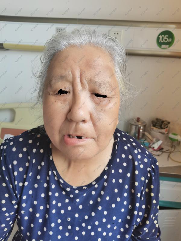 面瘫刺络拔罐放血治疗
