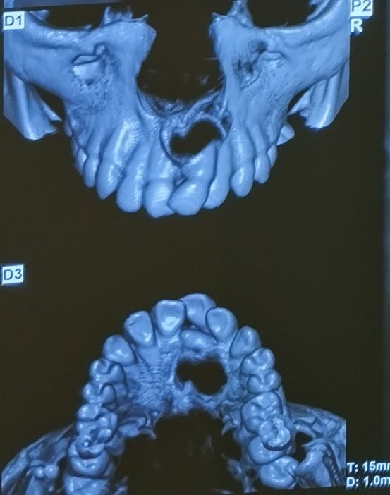 颅内多牙症图片图片