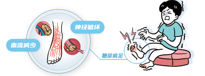 警惕糖尿病并发症"头号劲敌"——糖尿病周围神经痛 - 好大夫在线