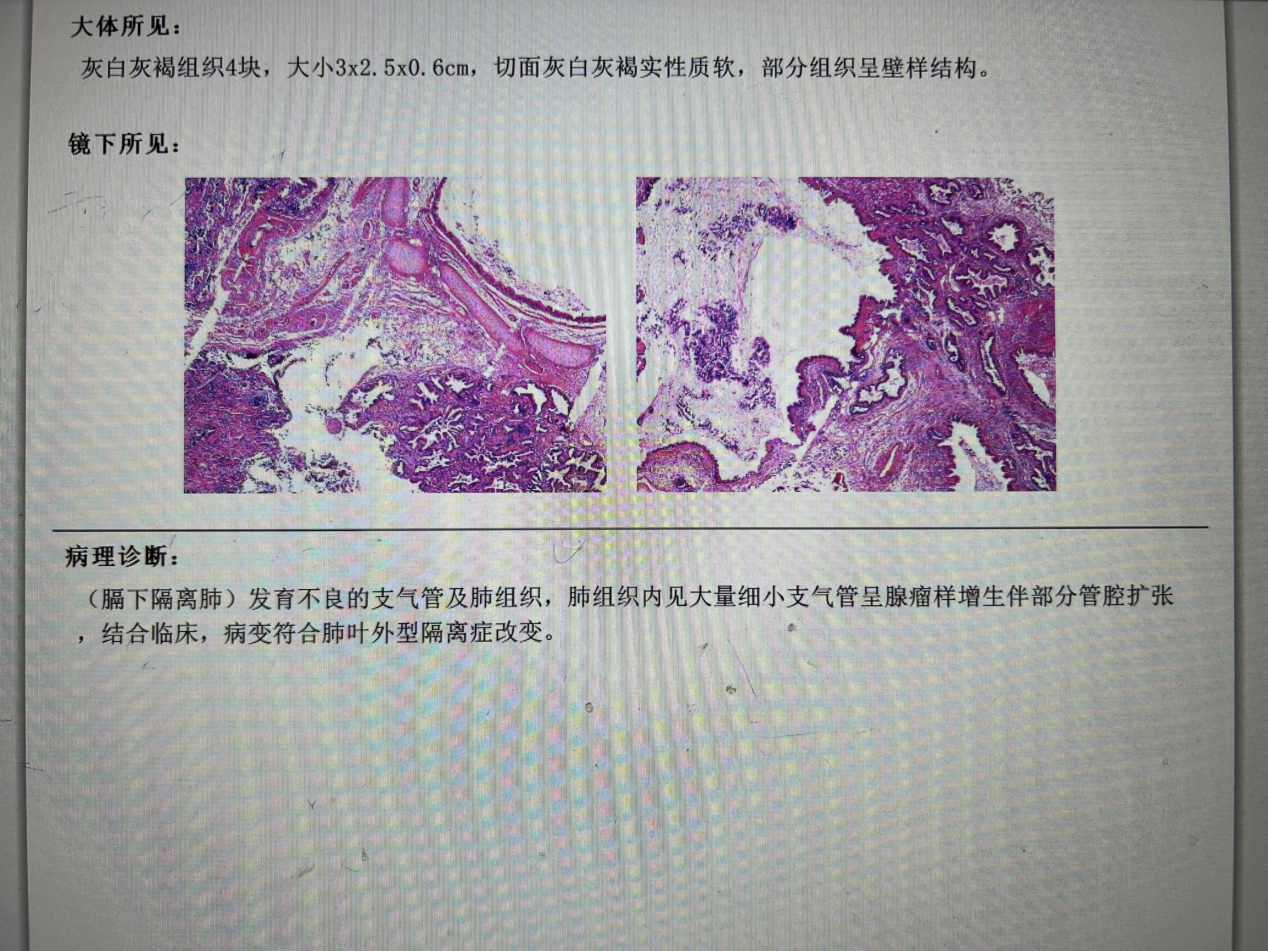 隔离肺手术费用图片