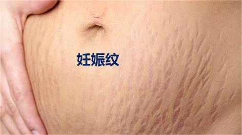 Stretch marks 妊辰纹.jpg