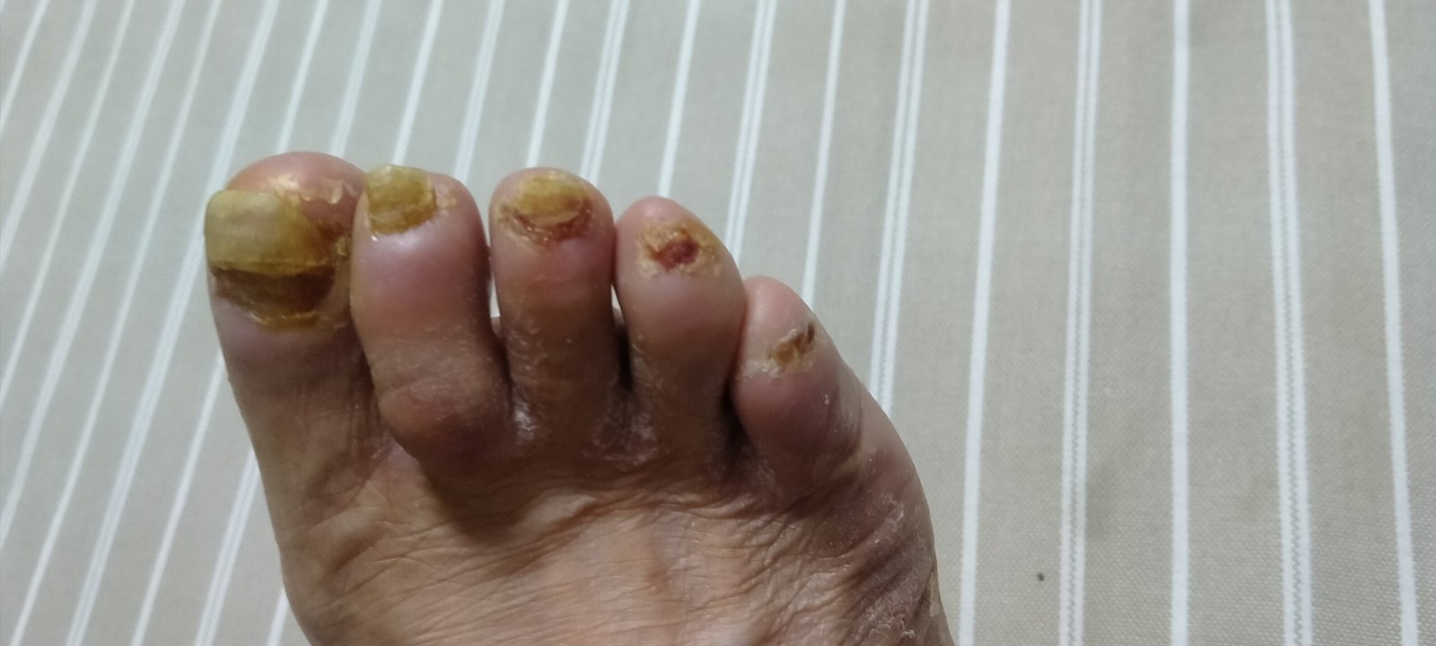 手足综合征治疗三天前后 - 好大夫在线