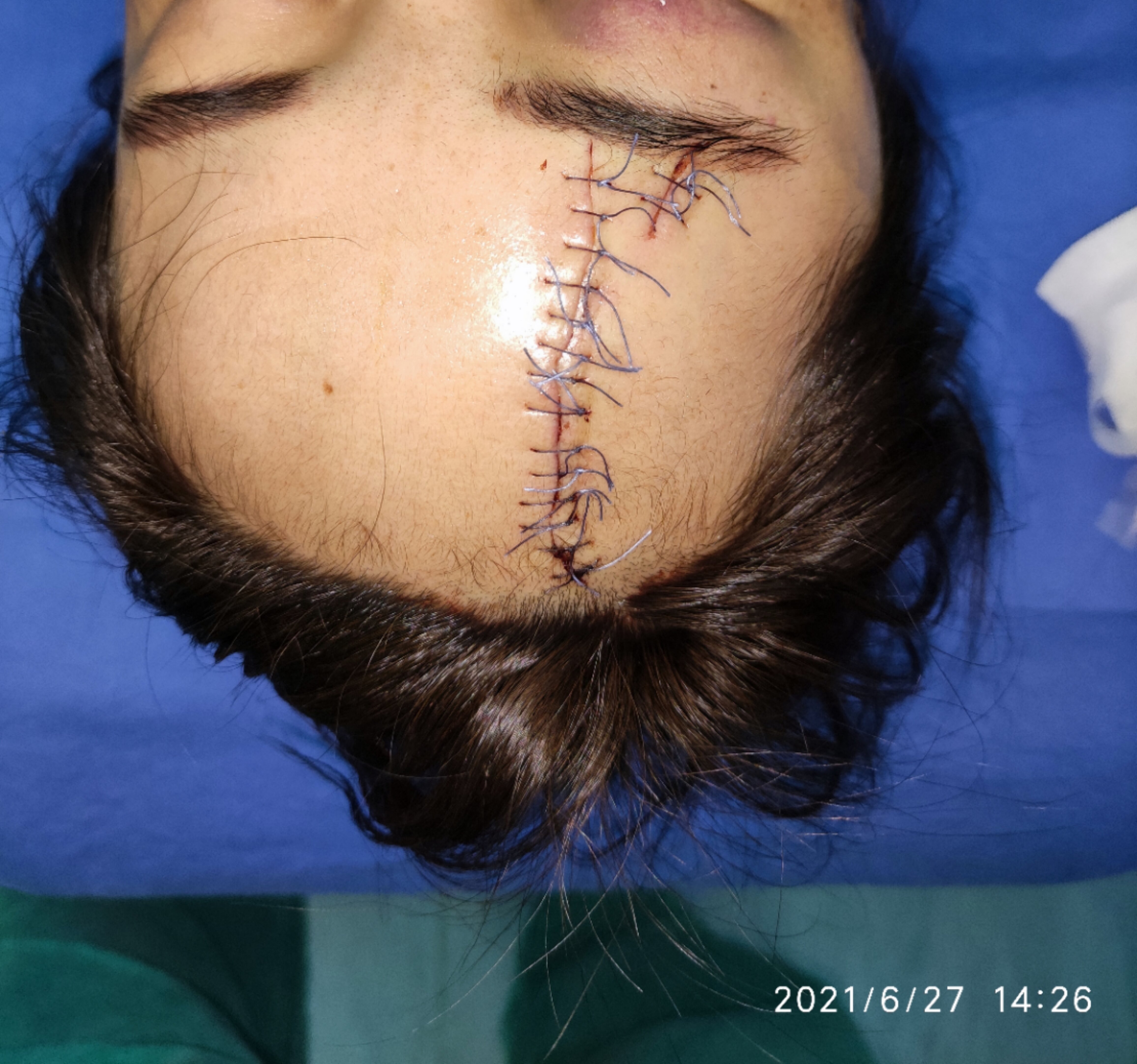 胳膊上的疤是什么疫苗6_胳膊上没有疫苗疤_胳膊上的疤是什么疫苗