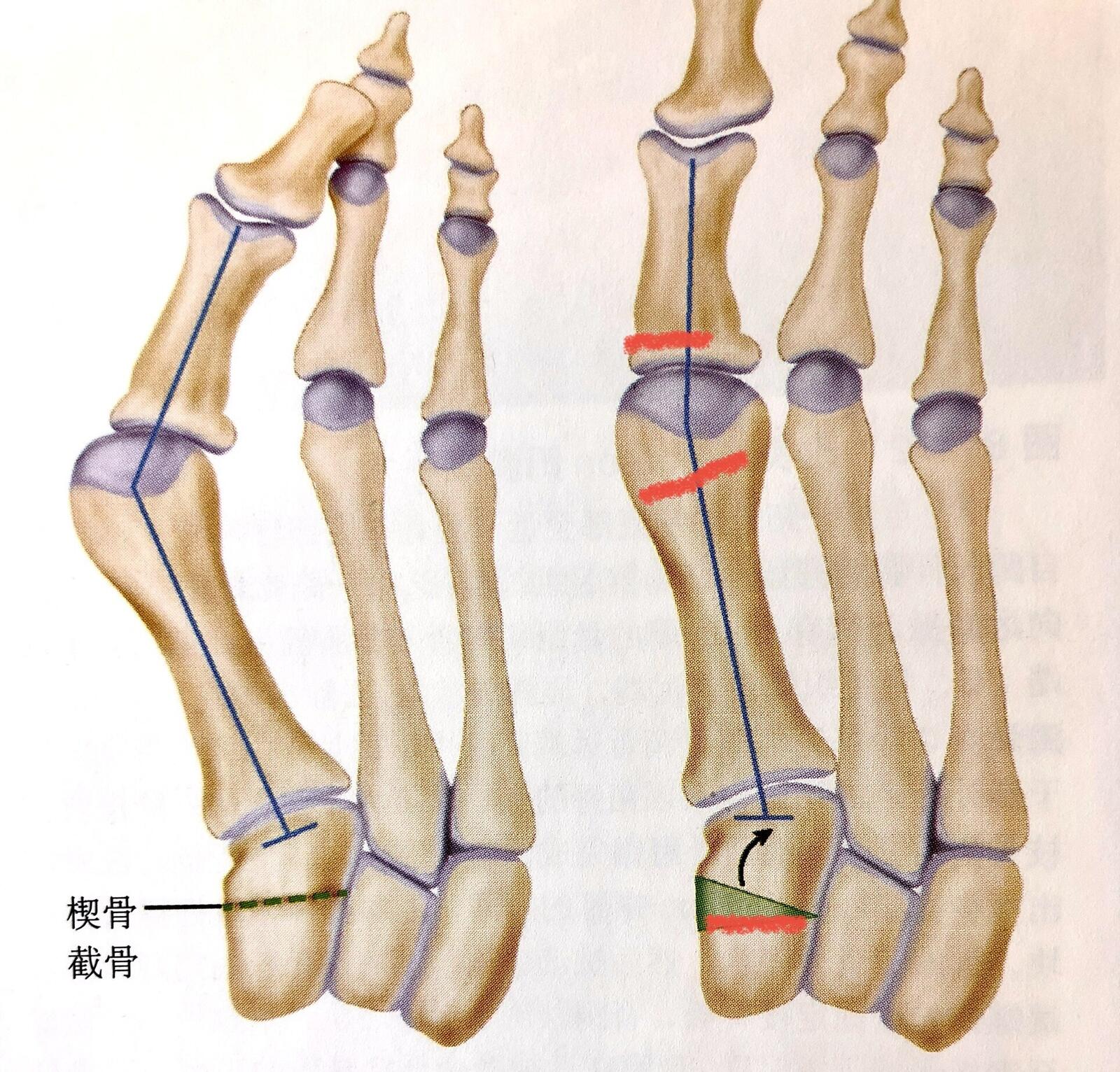 足部第一跖骨位置图图片