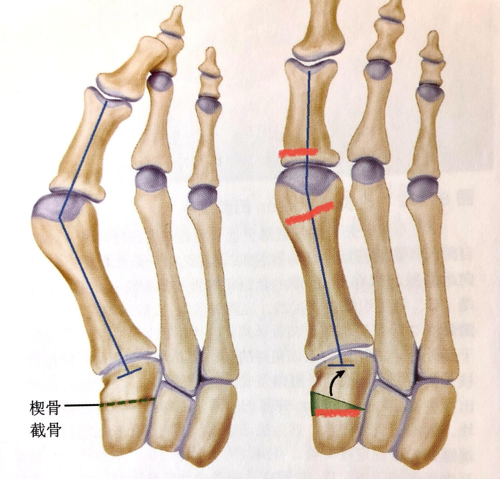 脚部第一楔骨图片