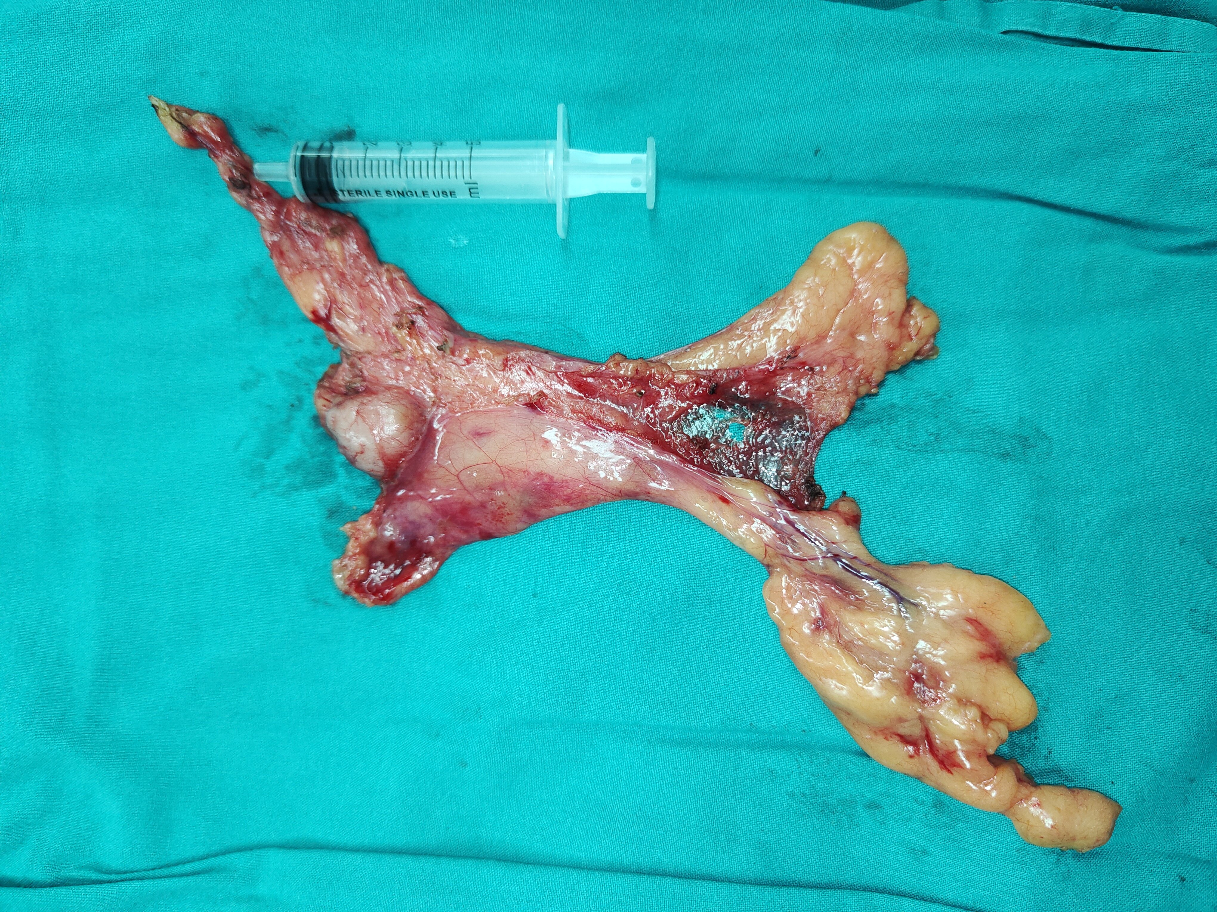 胸腺瘤的微创手术(剑突下单孔)之优缺点_胸腺瘤_胸腺瘤治疗方式 - 好