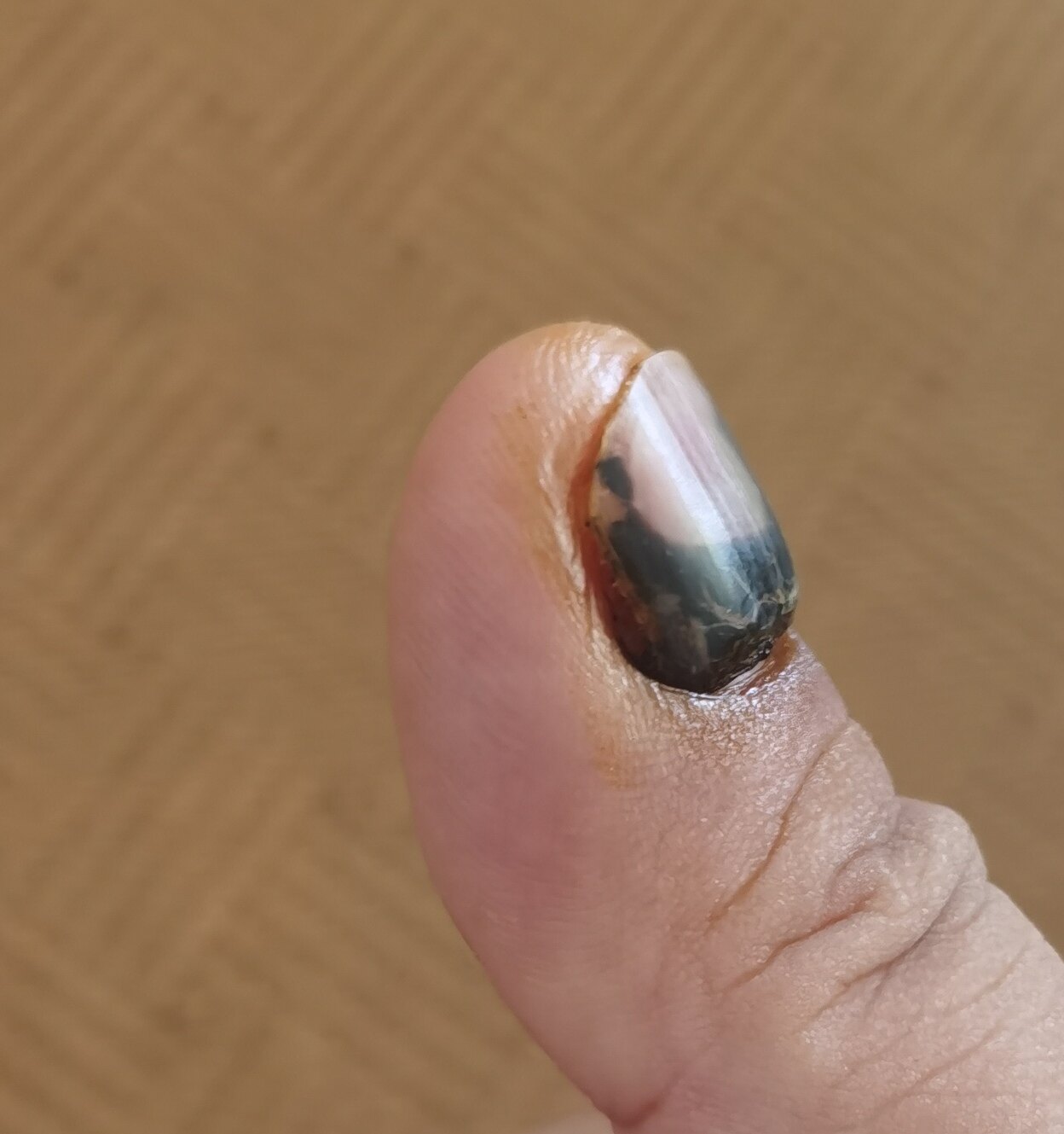 拇指指甲被夹后全都黑了,现在过了一个月,指甲中间的瘀血化掉了,但有