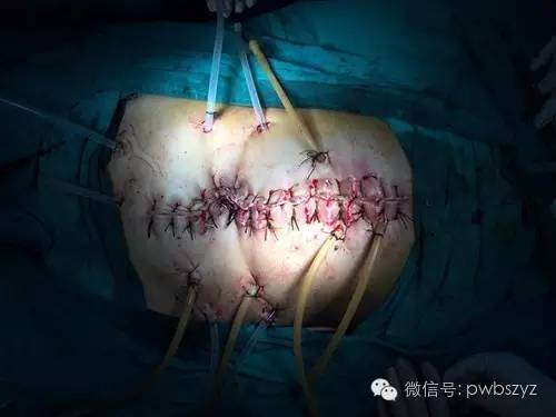 肠瘘肠梗阻典型病例系列之004----胃癌术后吻合口瘘 - 好大夫在线