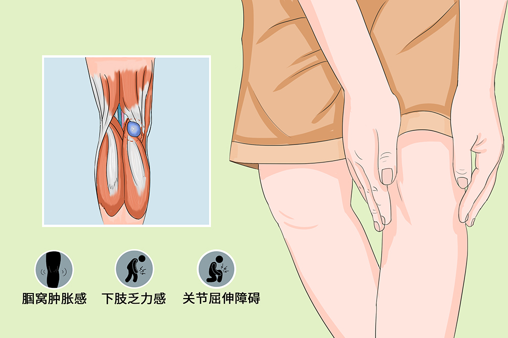 腘窝囊肿位置图片