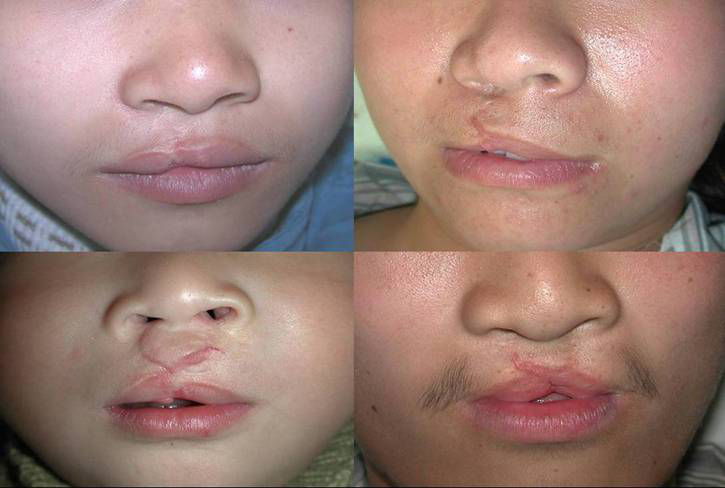唇裂术后疤痕变化过程图片