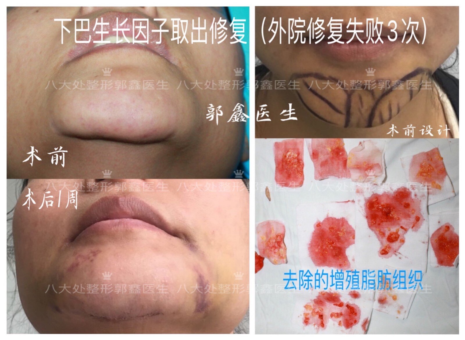 生长因子,童颜针,脂肪填充修复案例和简介(郭鑫医生)